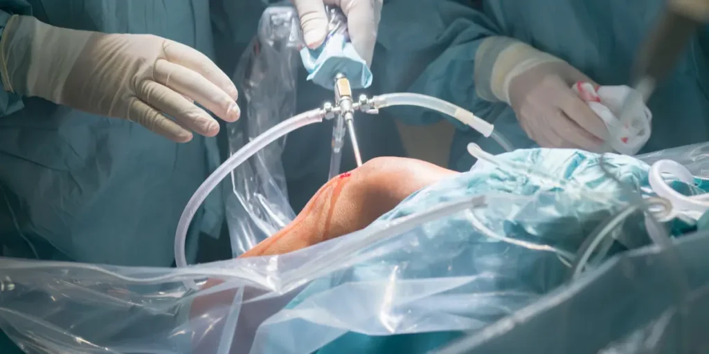 Descubra o Preço e Custo da Cirurgia de Prótese de Joelho Preço e Custo da Cirurgia de Prótese de Joelho